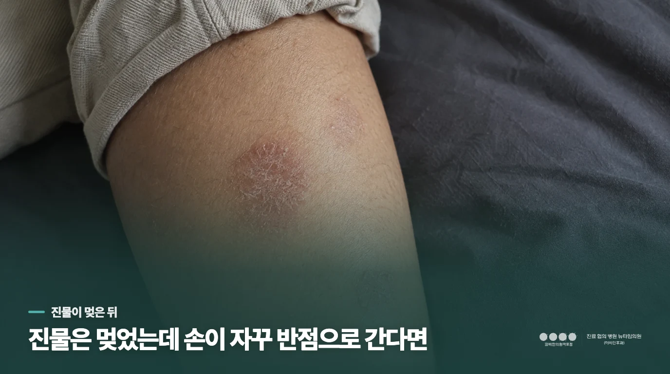 진물은 멎었는데 손이 자꾸 반점으로 간다면