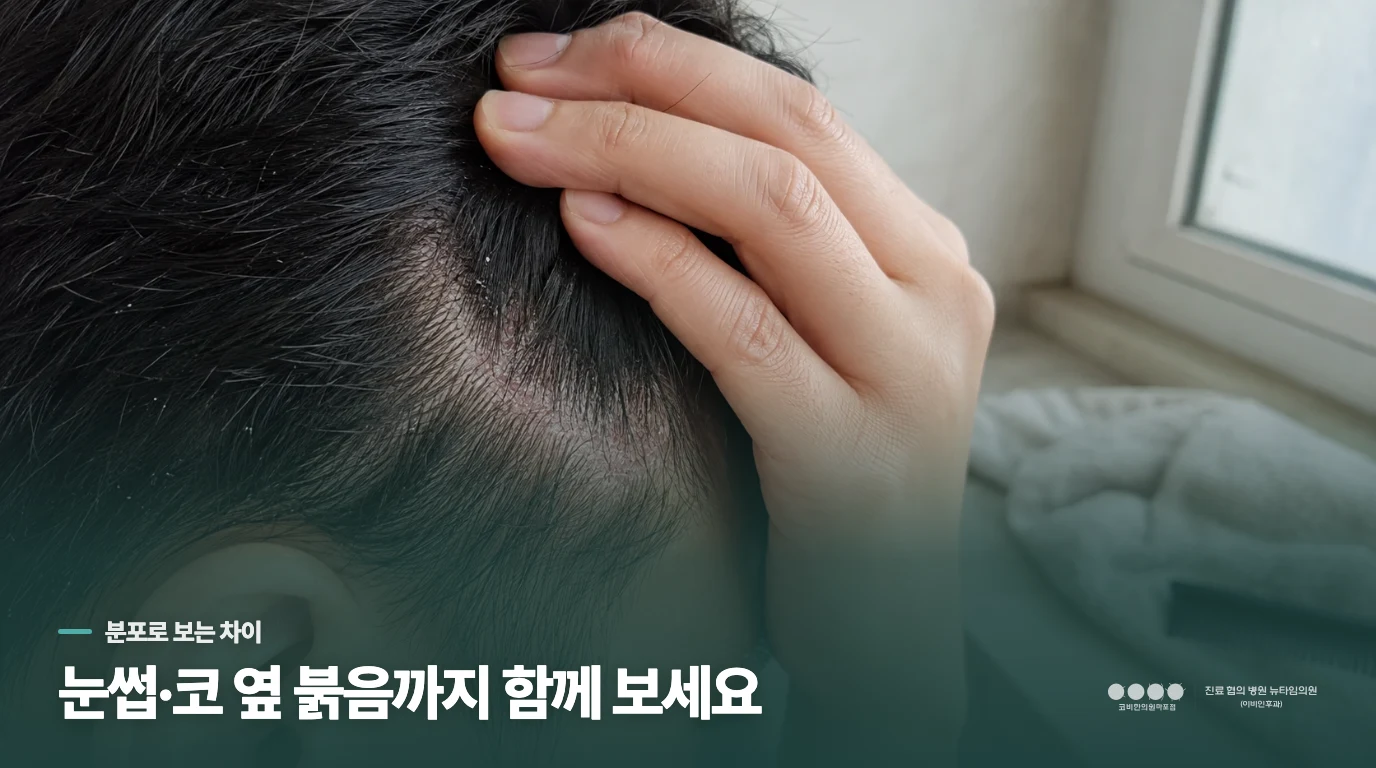 두피 비듬과 눈썹·코 옆 붉음은 함께 봅니다