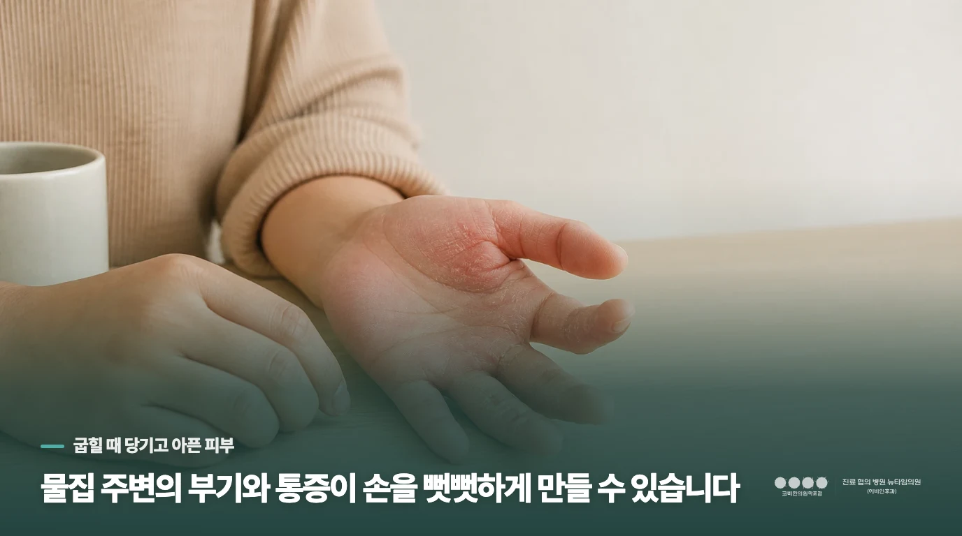 물집 주변의 부기와 통증이 손을 뻣뻣하게 만들 수 있습니다
