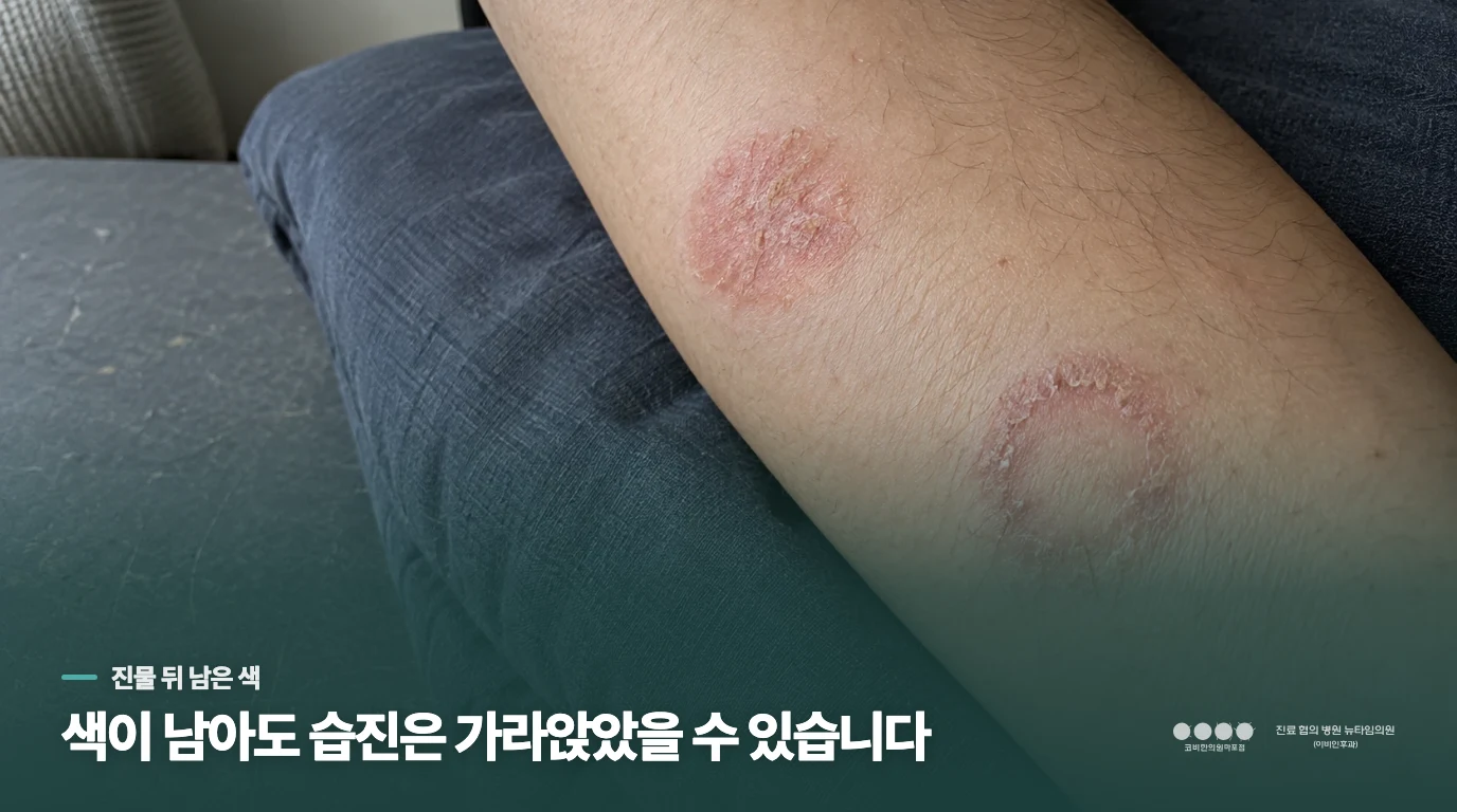 진물은 멎었는데 동그란 자국은 그대로입니다