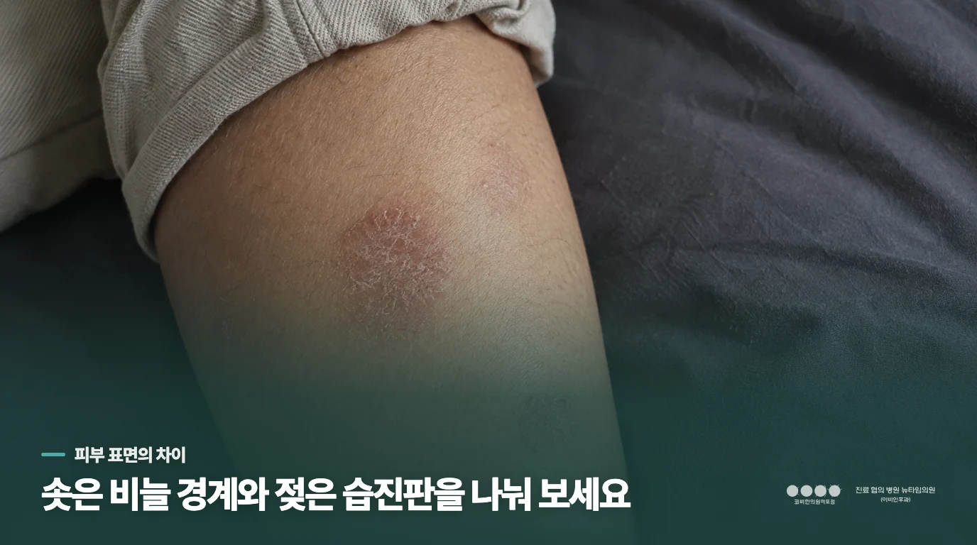 경계가 두드러지는지, 반점 전체가 젖고 가려운지 살펴보세요